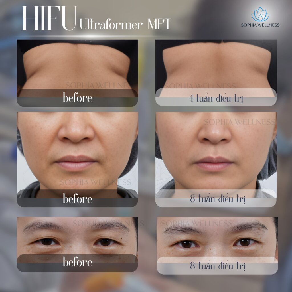 Soi công nghệ hàng dầu nâng cơ, trẻ hoá da HIFU ULTRAFORMER MPT - Say bye nếp nhăn, chảy xệ