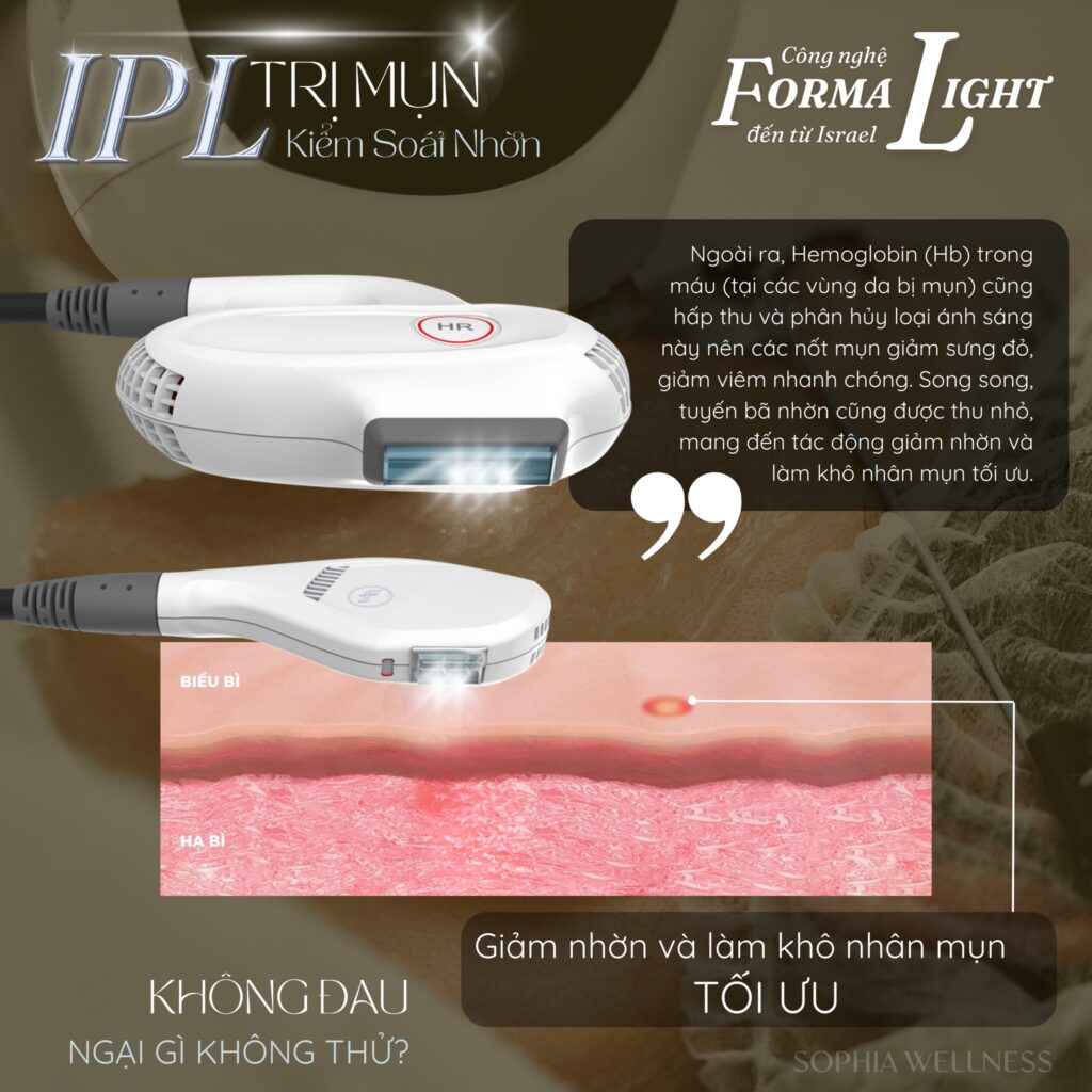 Điều trị mụn không xâm lấn cùng Công nghệ IPL – Không đau ngại gì không thử!