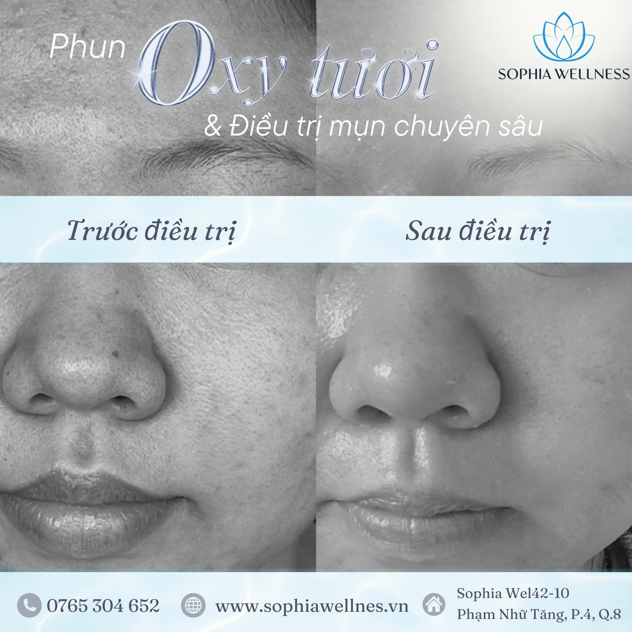 Ưu đãi tháng 9 – Đánh bay nỗi lo mụn dai dẳng cùng quy trình kiểm soát mụn chuẩn y khoa tại Sophia Wellness