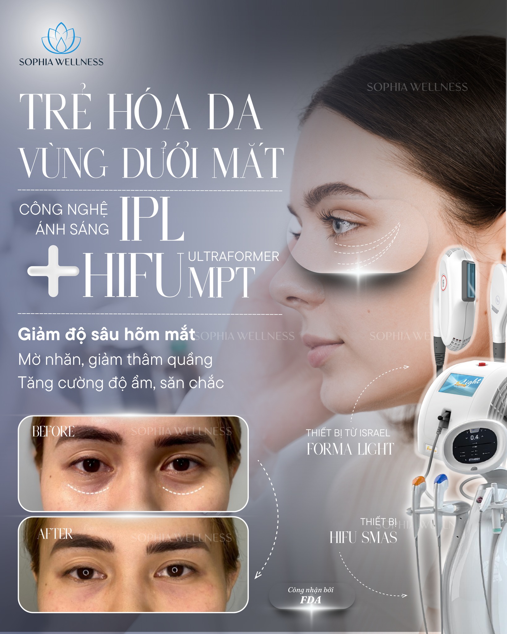 Trẻ hoá da vùng dưới mắt bằng Công nghệ ánh sáng IPL & HIFU SMAS: Đánh giá tác động & Phác đồ điều trị