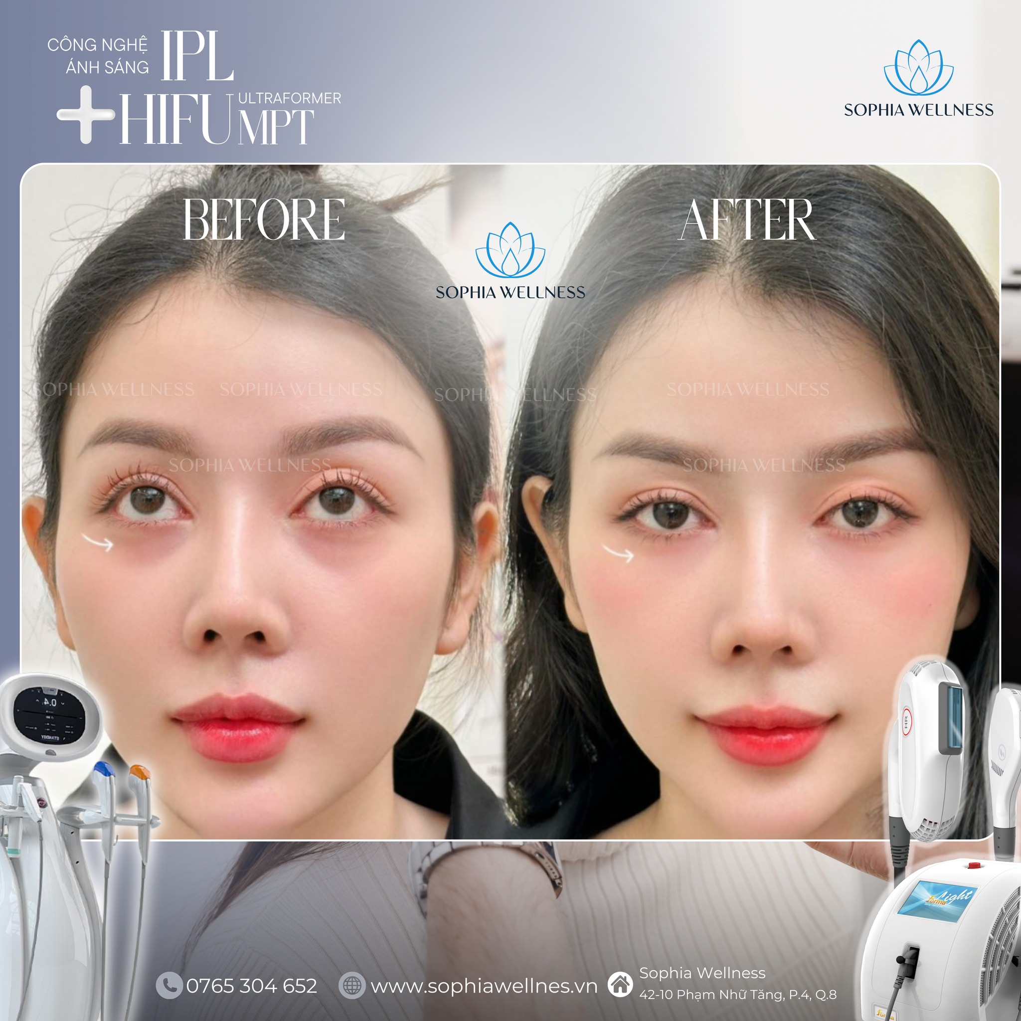 Trẻ hoá da vùng dưới mắt bằng Công nghệ ánh sáng IPL & HIFU SMAS: Đánh giá tác động & Phác đồ điều trị