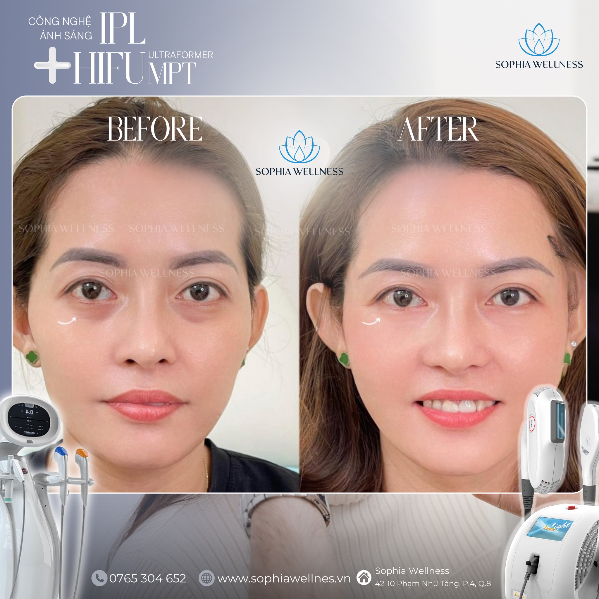 Trẻ hoá da vùng dưới mắt bằng Công nghệ ánh sáng IPL & HIFU SMAS: Đánh giá tác động & Phác đồ điều trị