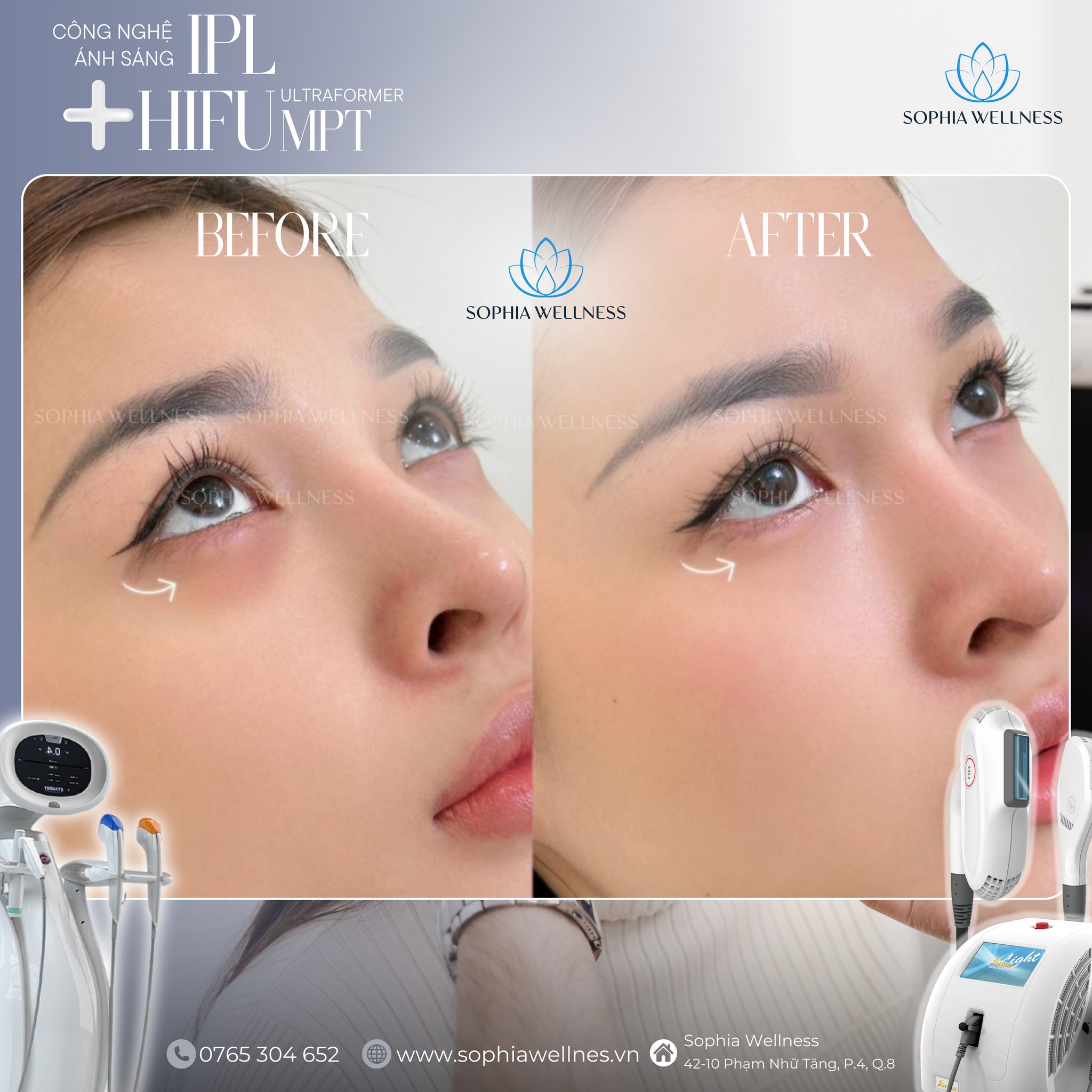 Trẻ hoá da vùng dưới mắt bằng Công nghệ ánh sáng IPL & HIFU SMAS: Đánh giá tác động & Phác đồ điều trị