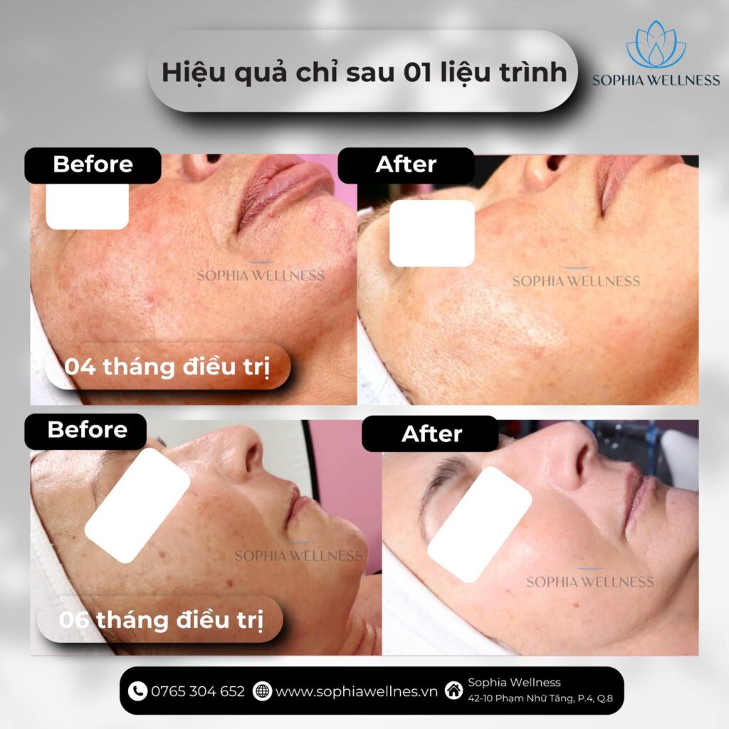 Mừng ngày Phụ nữ Việt Nam! Nâng niu bản thân với da trắng sáng cùng JETPEEL