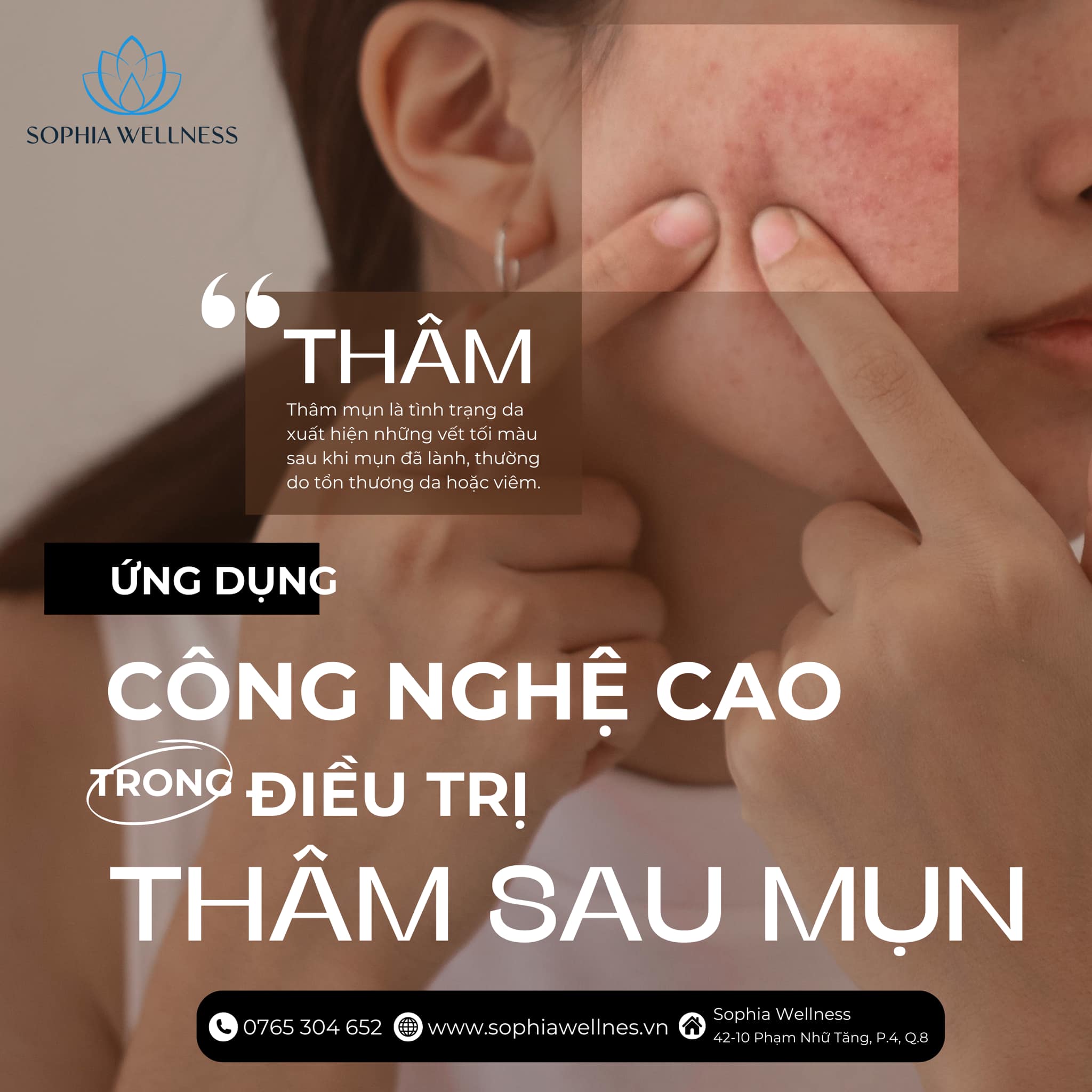 Tạm biệt nỗi lo thâm sau mụn: Giải pháp điều trị bằng công nghệ cao
