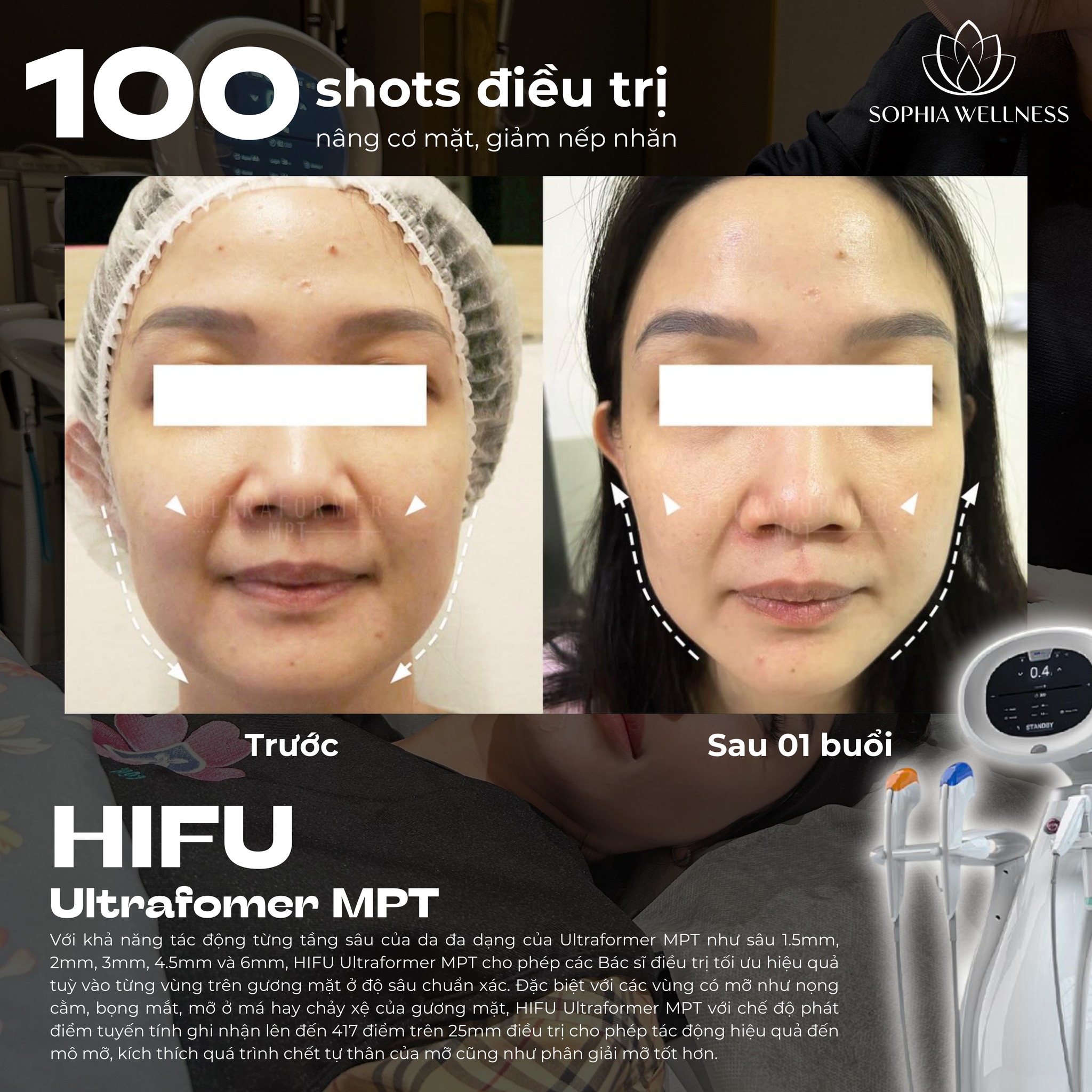 Tươi trẻ các đường nét trên khuôn mặt cùng Hifu Ultrafomer MPT - Công nghệ trẻ hoá da bậc nhất hiện nay