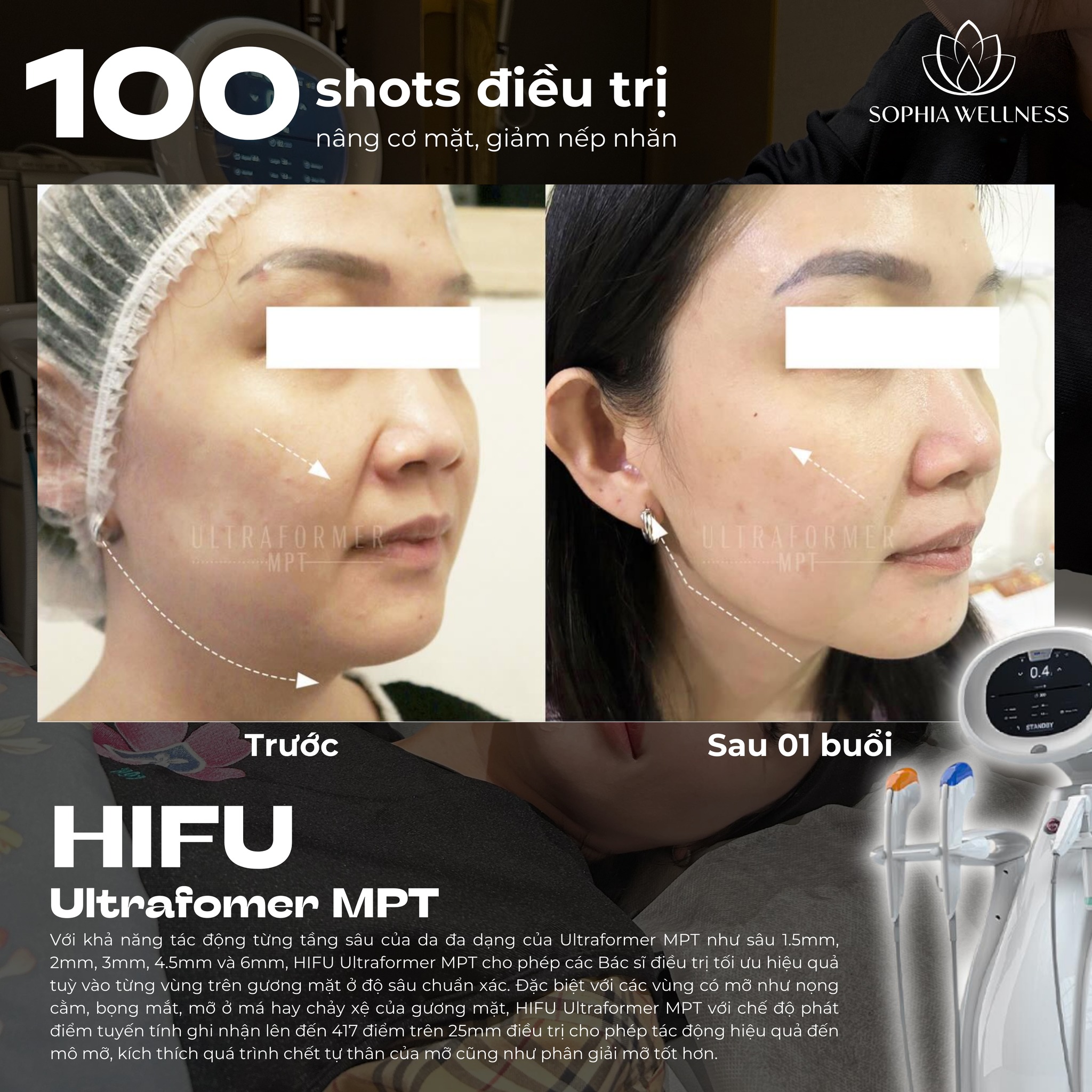 Tươi trẻ các đường nét trên khuôn mặt cùng Hifu Ultrafomer MPT - Công nghệ trẻ hoá da bậc nhất hiện nay
