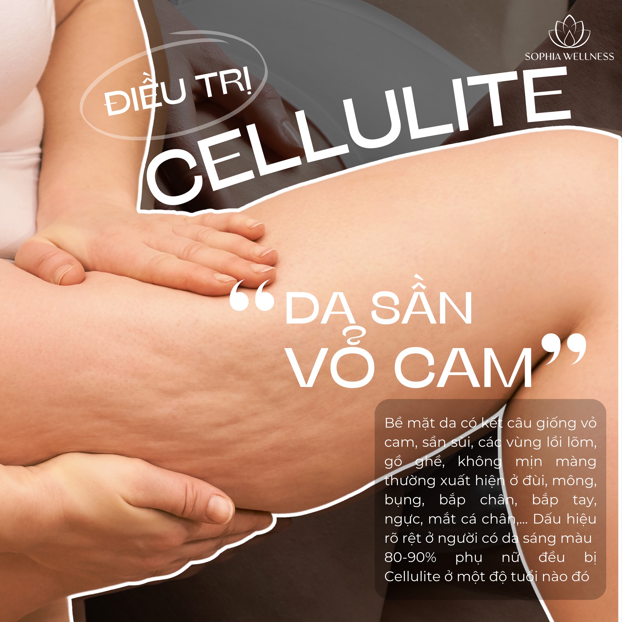 Da sần vỏ cam - Làm sao loại bỏ? Trải nghiệm liệu pháp công nghệ cao hàng đầu tại Sophia Wellness