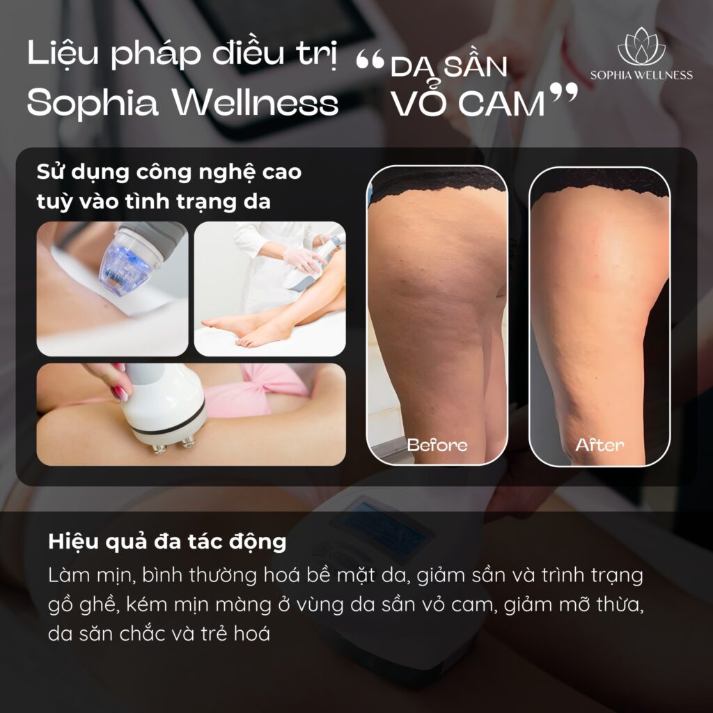 Da sần vỏ cam - Làm sao loại bỏ? Trải nghiệm liệu pháp công nghệ cao hàng đầu tại Sophia Wellness