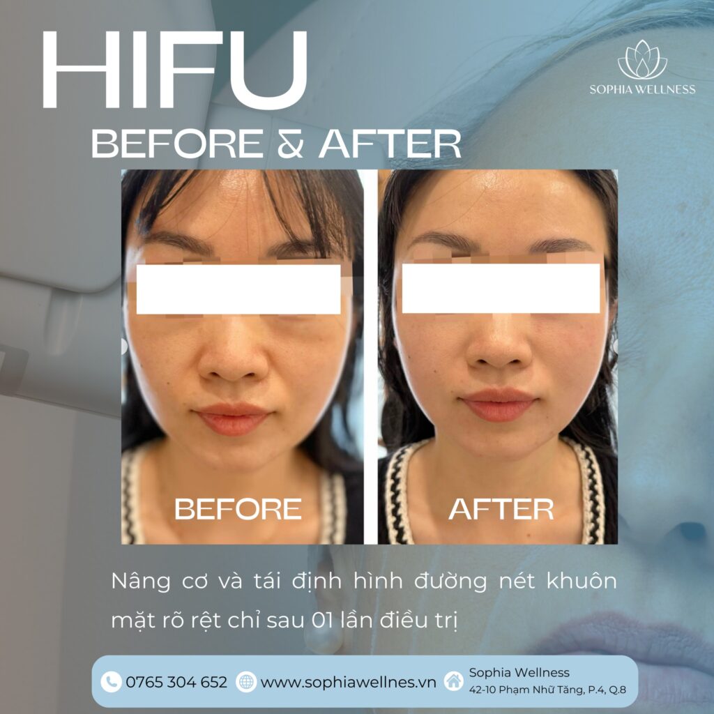 Bí quyết Trẻ hoá da Không xâm lấn cho độ tuổi 50: Công nghệ HIFU hay THERMAGE? Công nghệ nào là lựa chọn số 1 hiện nay?