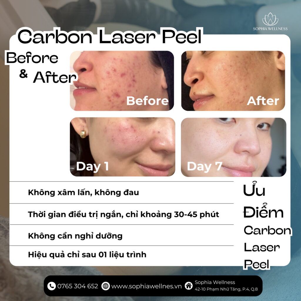 Rạng rỡ đón năm mới với liệu trình LASER CARBON PEEL