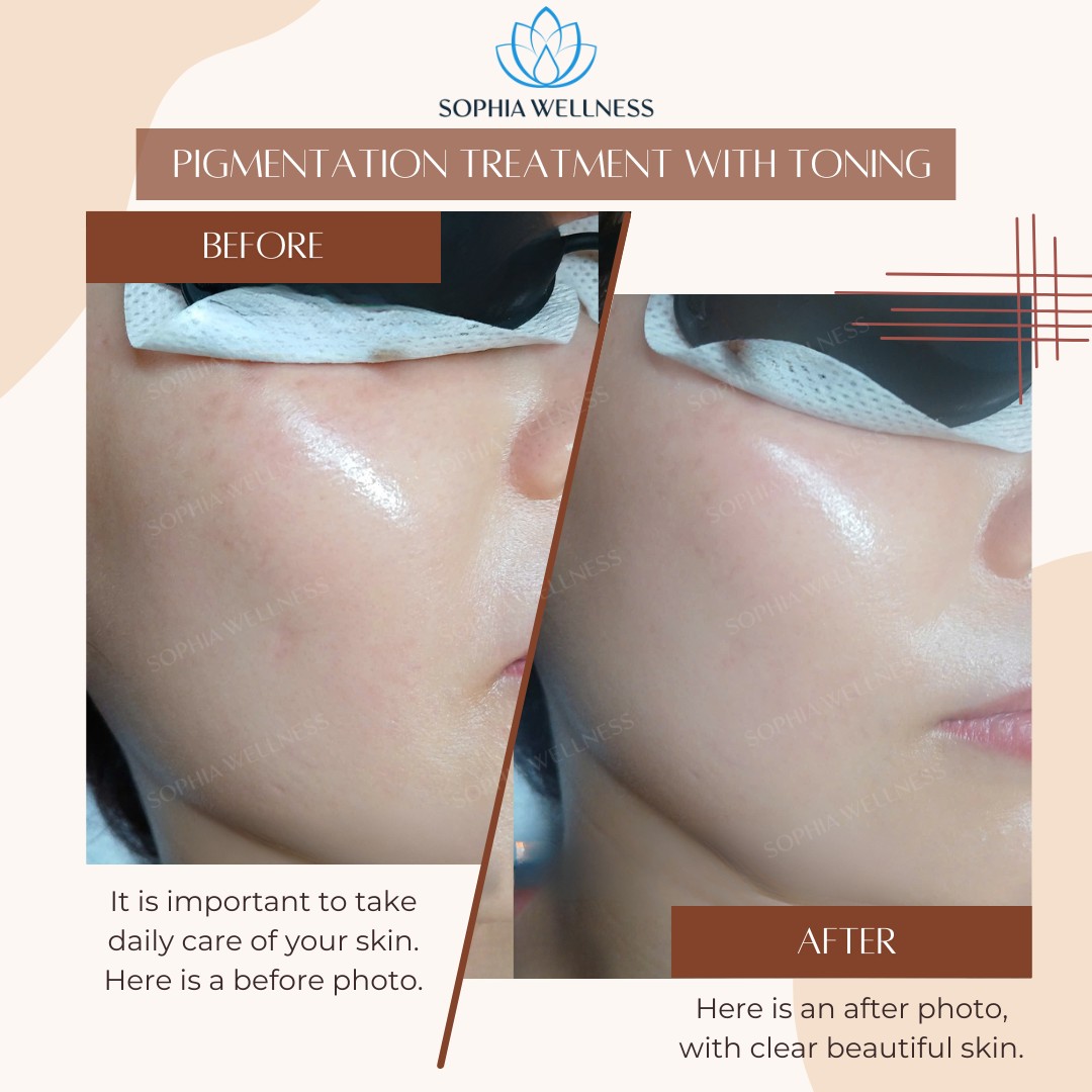 CẢI THIỆN SẮC TỐ DA VỚI CÔNG NGHỆ TONING