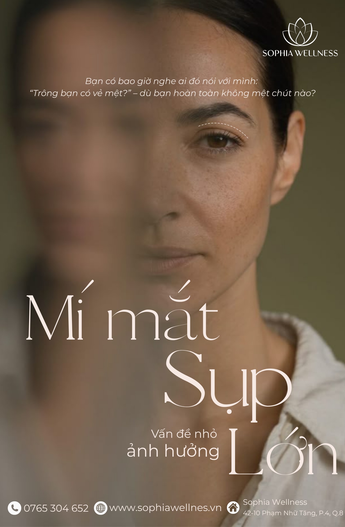 MÍ MẮT SỤP – VẤN ĐỀ NHỎ, ẢNH HƯỞNG LỚN
