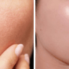 Làm mờ sẹo nhẹ, lỗ chân lông