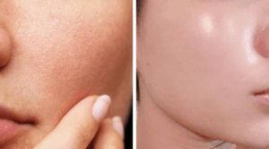 Làm mờ sẹo nhẹ, lỗ chân lông