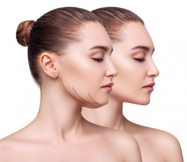 Cằm nọng (Double Chin) – 110 shot