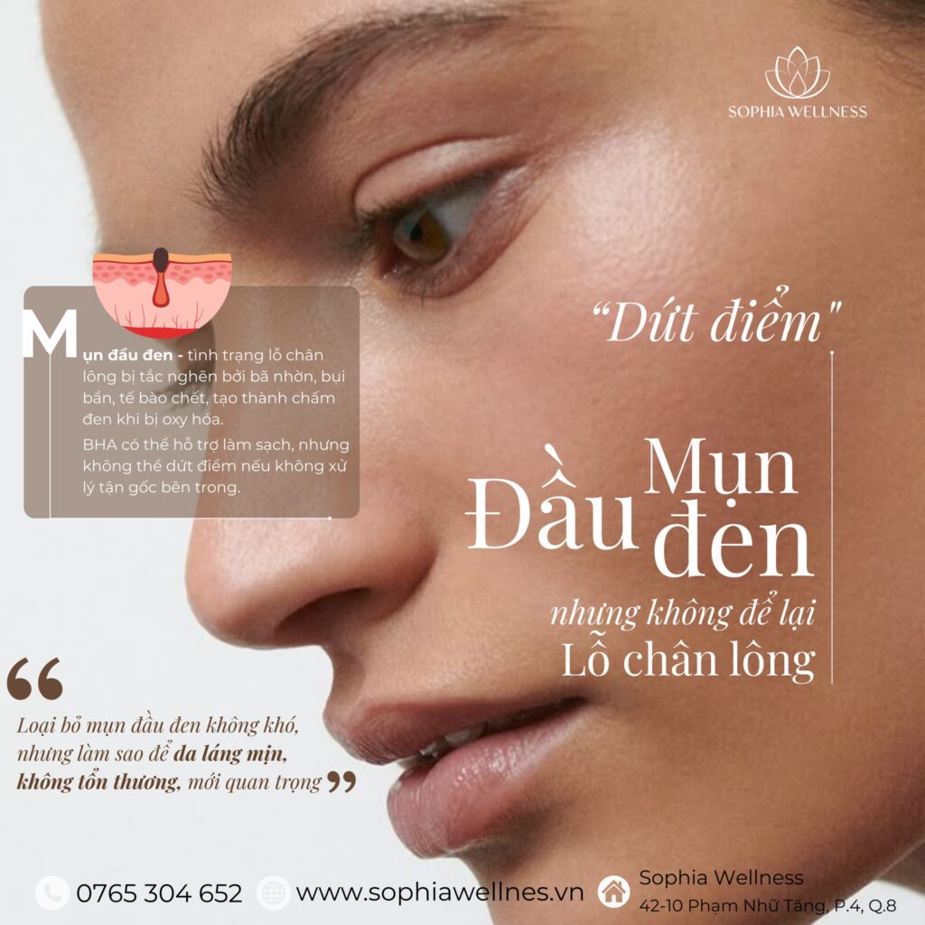 “DỨT ĐIỂM” MỤN ĐẦU ĐEN – KHÔNG ĐỂ LẠI LỖ CHÂN LÔNG