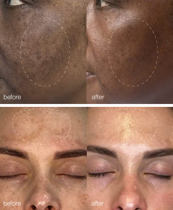 Hệ thống tái tạo Melano Pro - Ảnh 4