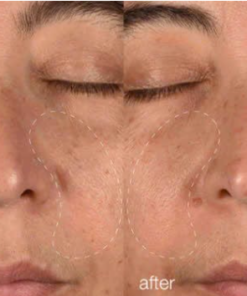 Alternative view of Hệ thống tái tạo Melano Pro