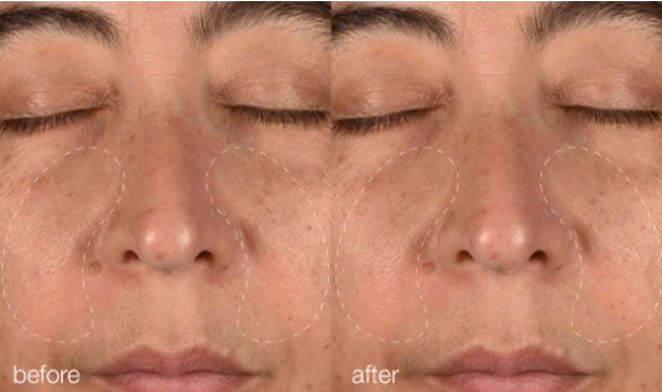 Hệ thống tái tạo Melano Pro - Ảnh 2